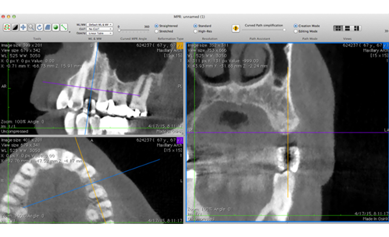 We need to check your bone with CT = 3D X-ray