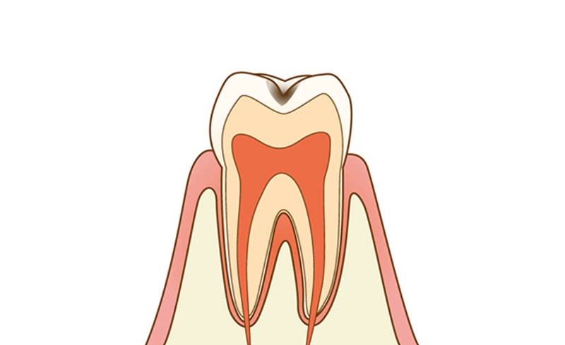 C1：エナメル質内の虫歯
