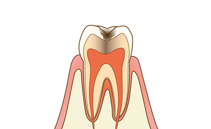 C2：象牙質に達した虫歯