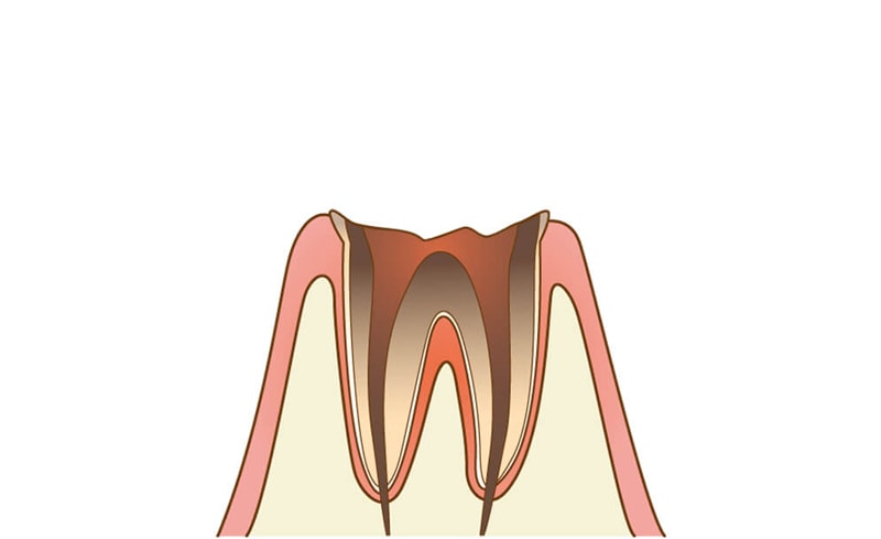 C4：歯質が失われた虫歯