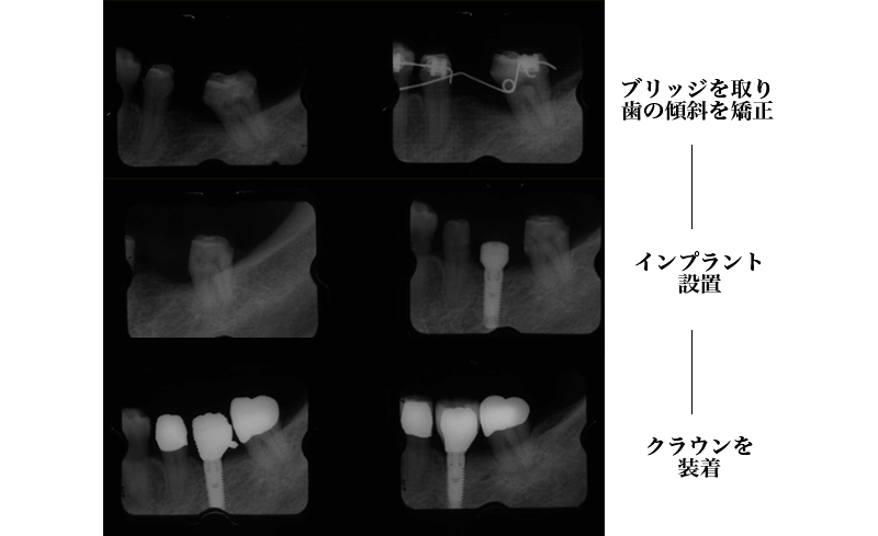 インプラント治療前の矯正治療