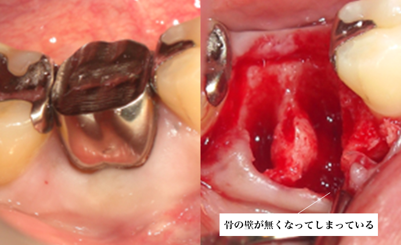 膜と骨補填材を使用して,骨の量を保存する