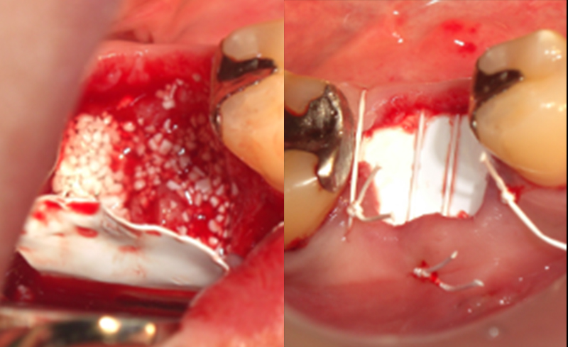 膜と骨補填材を使用して，骨の量を保存する
