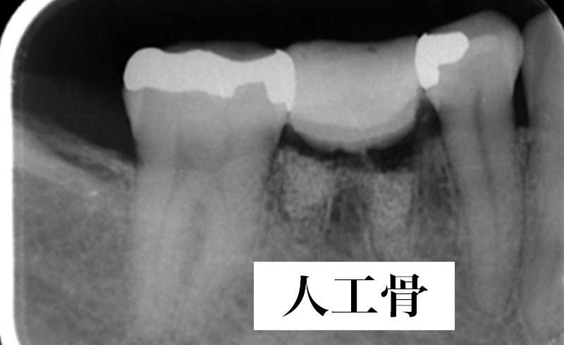 抜歯直後