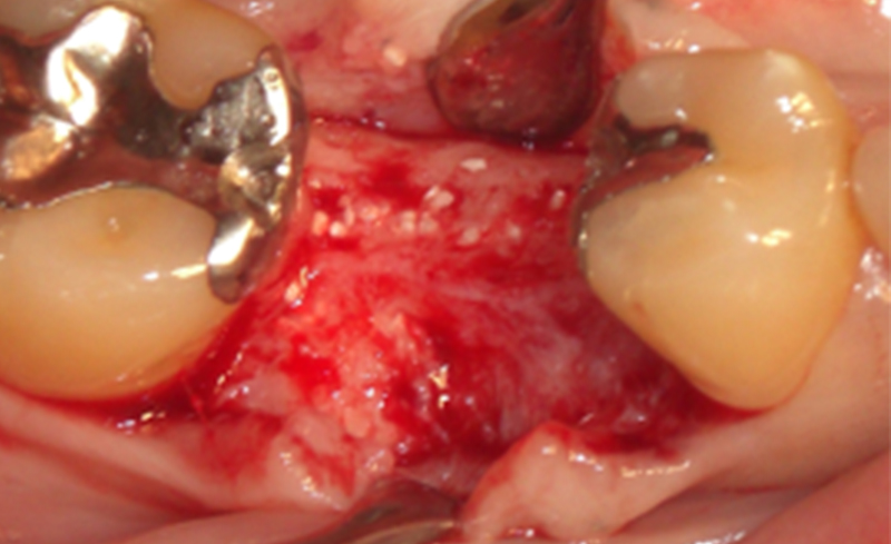 インプラント手術当日：骨の増生を確認