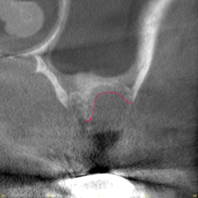左上臼歯1本にインプラント治療を施した1例