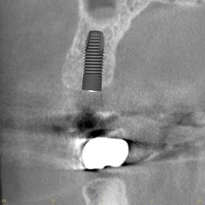 右上小臼歯１本にインプラント治療を施した1例