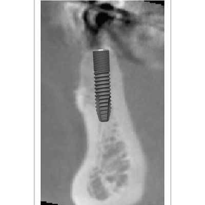 右下小臼歯１本にインプラント治療を施した1例