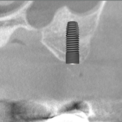 左上大臼歯１本にインプラント治療を施した1例