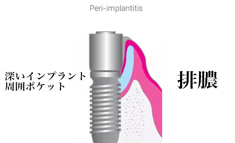 インプラント周囲炎