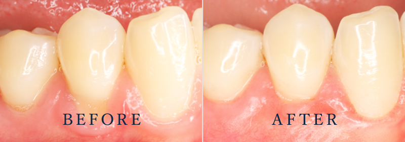 Before After